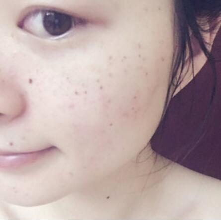 激光祛斑对比图 激光祛斑对比图