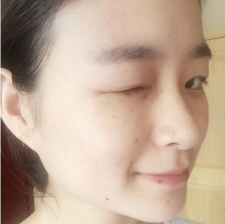 激光祛斑对比图 激光祛斑对比图