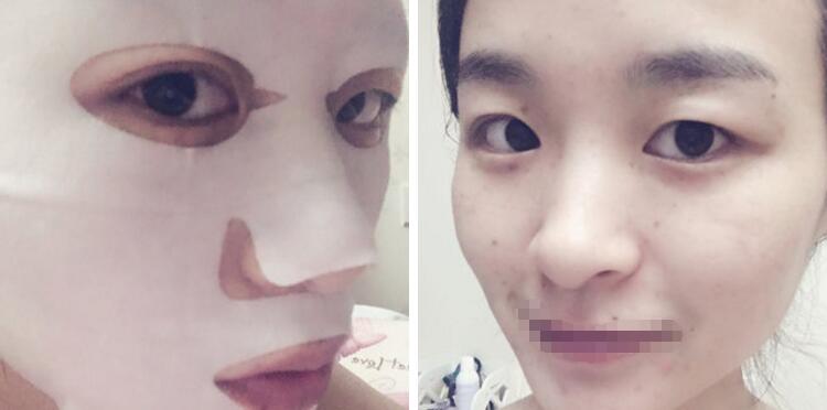 激光祛斑对比图 激光祛斑对比图