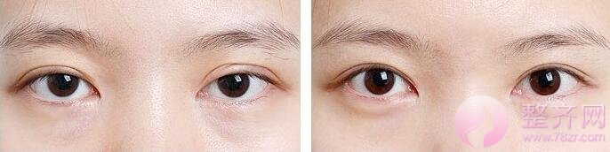 双眼皮修复术 看看你的双眼皮修复难吗