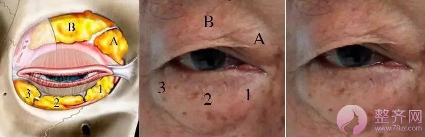 肿泡眼去脂后眼皮还是厚，是手术失败了吗？
