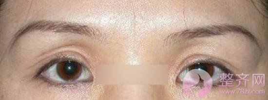 肿泡眼去脂后眼皮还是厚，是手术失败了吗？