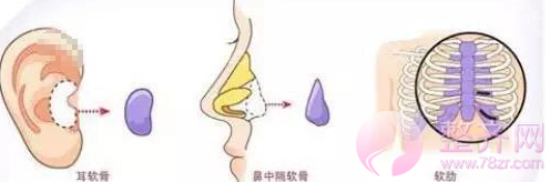 自体软骨隆鼻,自然型隆鼻方式