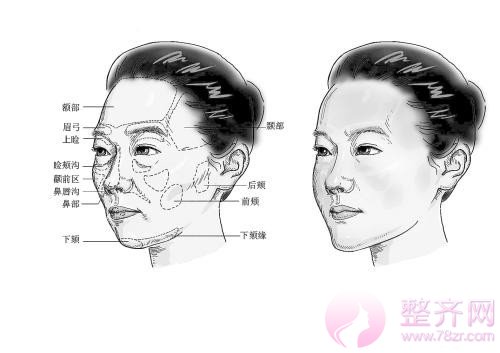 自体脂肪填充面部如何避免寿星头和僵硬脸?