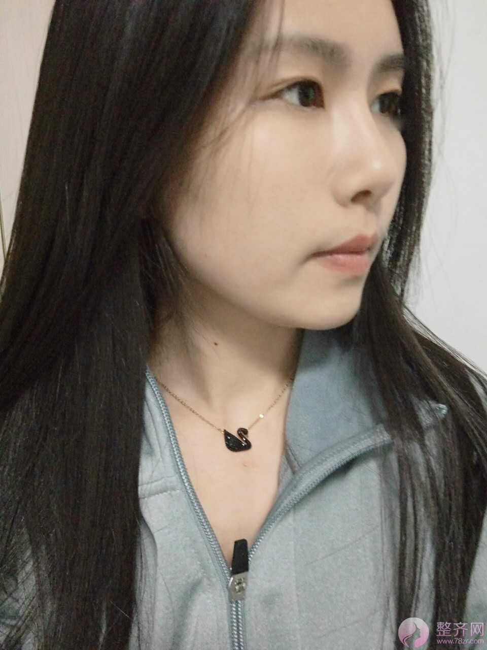 自体脂肪填充不自然?这些坑一定要避开!