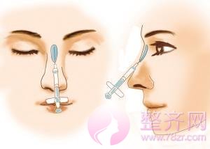 注射、埋线提升、假体、自体和综合隆鼻五种隆鼻方