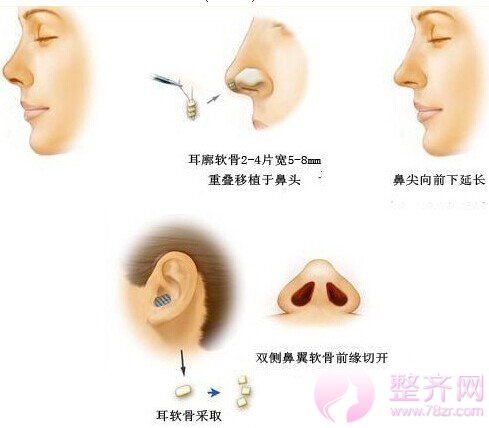 注射、埋线提升、假体、自体和综合隆鼻五种隆鼻方