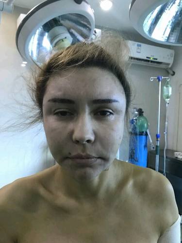 脂肪填充脸部的美丽日记【案例】