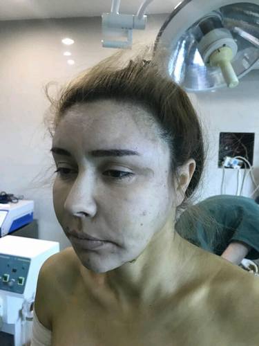 脂肪填充脸部的美丽日记【案例】