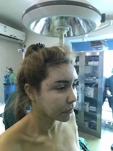 脂肪填充脸部的美丽日记【案例】