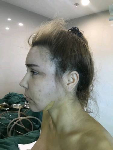 脂肪填充脸部的美丽日记【案例】