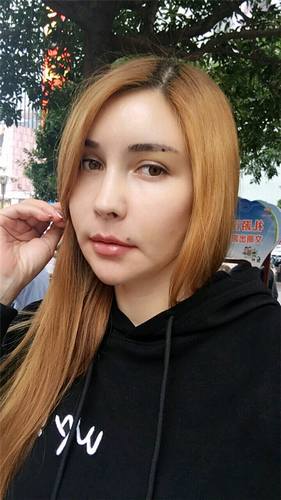 脂肪填充脸部的美丽日记【案例】