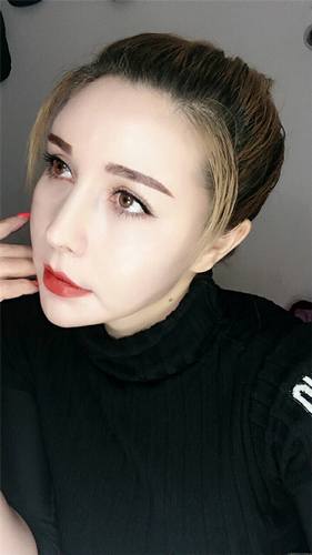 脂肪填充脸部的美丽日记【案例】