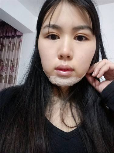 南宁农霖自体脂肪垫下巴术前术后对比