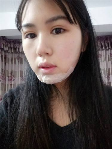 南宁农霖自体脂肪垫下巴术前术后对比
