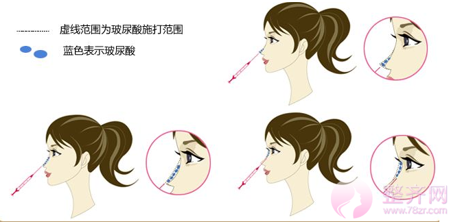 【用哪种手术方法可以改良塌鼻子呢】