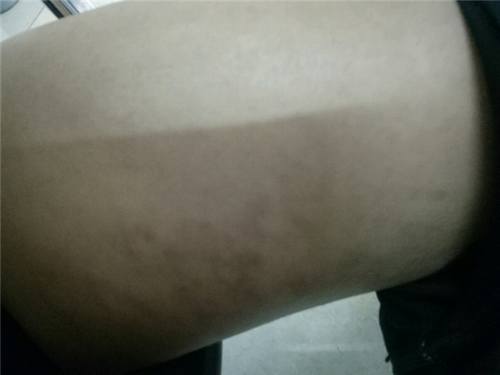 成都艾米丽吸脂瘦大腿