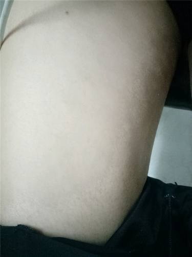 成都艾米丽吸脂瘦大腿