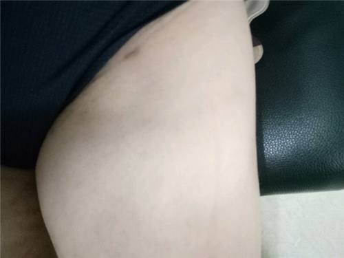 成都艾米丽吸脂瘦大腿