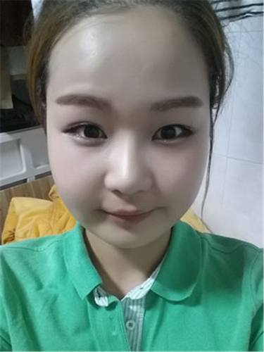 脂肪填充面部,让我再次体验了蜕变的感觉有多美妙!!!想要变美的女生看过来,给你们分享我的变美经历啦~~~~