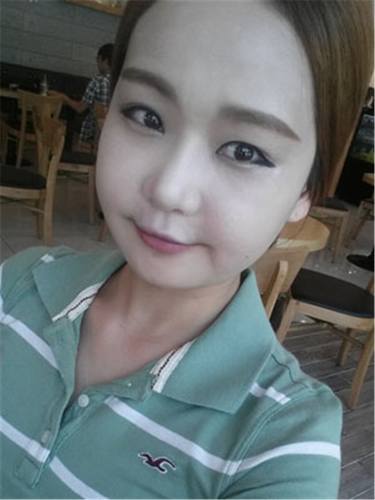 脂肪填充面部,让我再次体验了蜕变的感觉有多美妙!!!想要变美的女生看过来,给你们分享我的变美经历啦~~~~