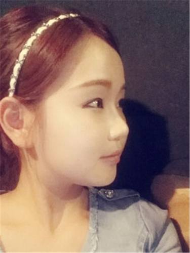 脂肪填充面部,让我再次体验了蜕变的感觉有多美妙!!!想要变美的女生看过来,给你们分享我的变美经历啦~~~~