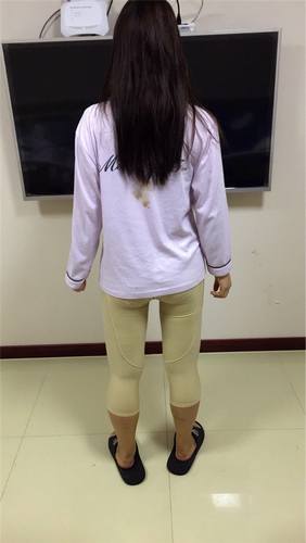 成都艾米丽刘叔阳吸脂瘦大腿