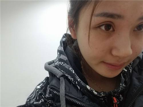 芜湖瑞丽翟奔宇自体脂肪丰太阳穴