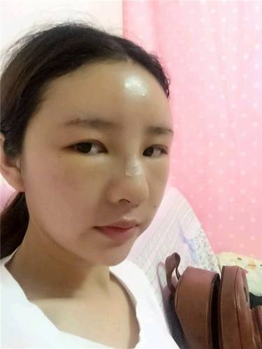 给姐妹们看看我的自体脂肪填充案例，过年再也不怕和朋友出去聚餐了！！变得美美的，大家可不要羡慕我哦，哈哈哈哈，下面给大家看看我的变美经历！哇咔咔，嘿嘿~~~~