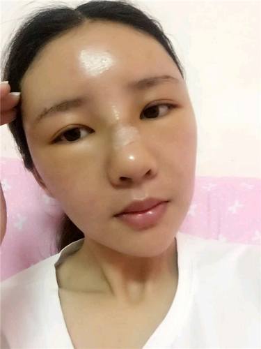 给姐妹们看看我的自体脂肪填充案例，过年再也不怕和朋友出去聚餐了！！变得美美的，大家可不要羡慕我哦，哈哈哈哈，下面给大家看看我的变美经历！哇咔咔，嘿嘿~~~~