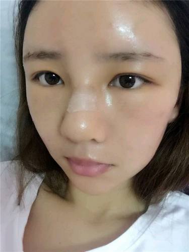 给姐妹们看看我的自体脂肪填充案例，过年再也不怕和朋友出去聚餐了！！变得美美的，大家可不要羡慕我哦，哈哈哈哈，下面给大家看看我的变美经历！哇咔咔，嘿嘿~~~~