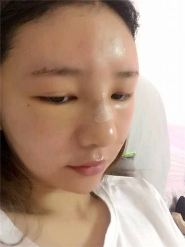 给姐妹们看看我的自体脂肪填充案例，过年再也不怕和朋友出去聚餐了！！变得美美的，大家可不要羡慕我哦，哈哈哈哈，下面给大家看看我的变美经历！哇咔咔，嘿嘿~~~~