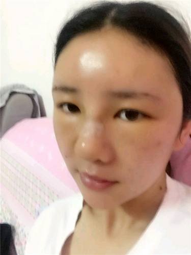 给姐妹们看看我的自体脂肪填充案例，过年再也不怕和朋友出去聚餐了！！变得美美的，大家可不要羡慕我哦，哈哈哈哈，下面给大家看看我的变美经历！哇咔咔，嘿嘿~~~~