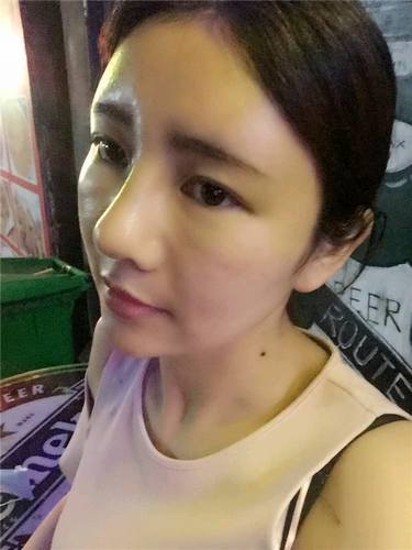 给姐妹们看看我的自体脂肪填充案例，过年再也不怕和朋友出去聚餐了！！变得美美的，大家可不要羡慕我哦，哈哈哈哈，下面给大家看看我的变美经历！哇咔咔，嘿嘿~~~~