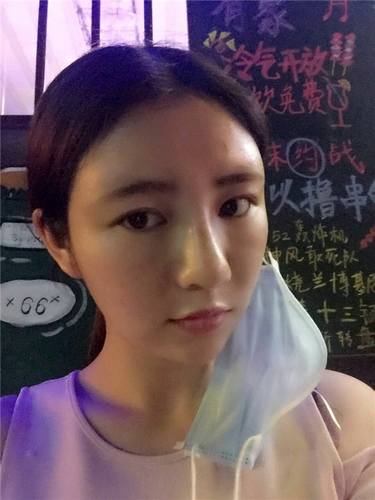 给姐妹们看看我的自体脂肪填充案例，过年再也不怕和朋友出去聚餐了！！变得美美的，大家可不要羡慕我哦，哈哈哈哈，下面给大家看看我的变美经历！哇咔咔，嘿嘿~~~~