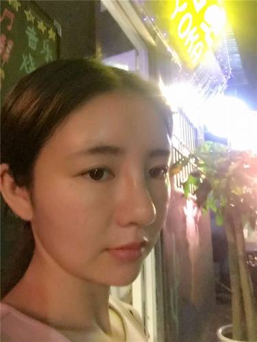 给姐妹们看看我的自体脂肪填充案例，过年再也不怕和朋友出去聚餐了！！变得美美的，大家可不要羡慕我哦，哈哈哈哈，下面给大家看看我的变美经历！哇咔咔，嘿嘿~~~~