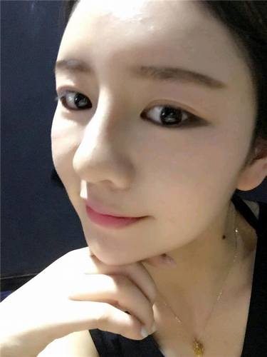 给姐妹们看看我的自体脂肪填充案例，过年再也不怕和朋友出去聚餐了！！变得美美的，大家可不要羡慕我哦，哈哈哈哈，下面给大家看看我的变美经历！哇咔咔，嘿嘿~~~~