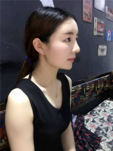 给姐妹们看看我的自体脂肪填充案例，过年再也不怕和朋友出去聚餐了！！变得美美的，大家可不要羡慕我哦，哈哈哈哈，下面给大家看看我的变美经历！哇咔咔，嘿嘿~~~~