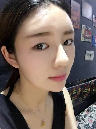 给姐妹们看看我的自体脂肪填充案例，过年再也不怕和朋友出去聚餐了！！变得美美的，大家可不要羡慕我哦，哈哈哈哈，下面给大家看看我的变美经历！哇咔咔，嘿嘿~~~~