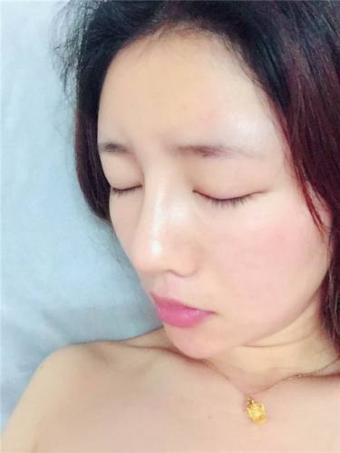 给姐妹们看看我的自体脂肪填充案例，过年再也不怕和朋友出去聚餐了！！变得美美的，大家可不要羡慕我哦，哈哈哈哈，下面给大家看看我的变美经历！哇咔咔，嘿嘿~~~~