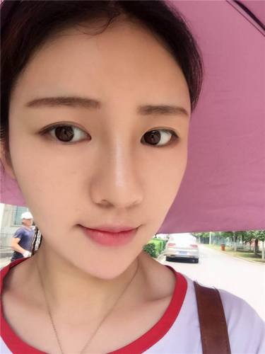 给姐妹们看看我的自体脂肪填充案例，过年再也不怕和朋友出去聚餐了！！变得美美的，大家可不要羡慕我哦，哈哈哈哈，下面给大家看看我的变美经历！哇咔咔，嘿嘿~~~~