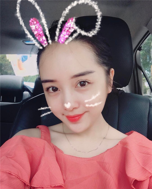 小姐姐们，进来看看我的神奇变美经历！自体脂肪丰太阳穴后脸部轮廓美的不行~~~~嗨嗨嗨拍照再也不用各种找角度了嘻嘻~~