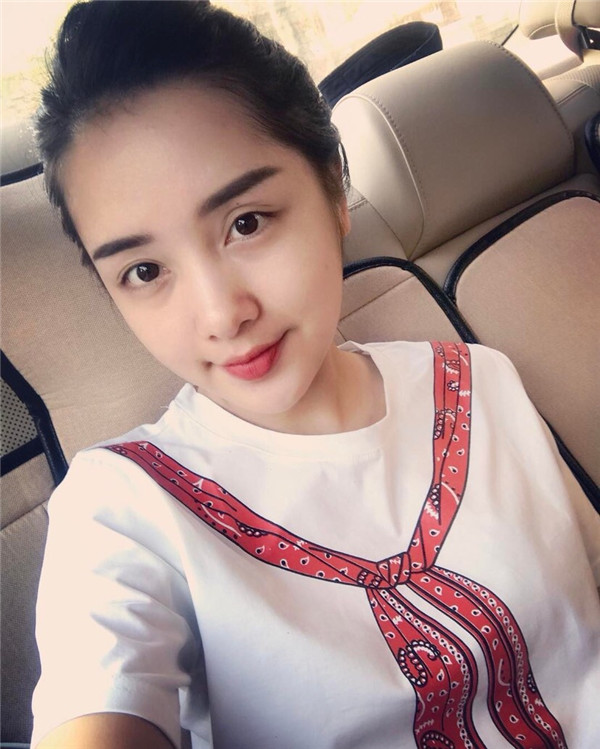 小姐姐们，进来看看我的神奇变美经历！自体脂肪丰太阳穴后脸部轮廓美的不行~~~~嗨嗨嗨拍照再也不用各种找角度了嘻嘻~~