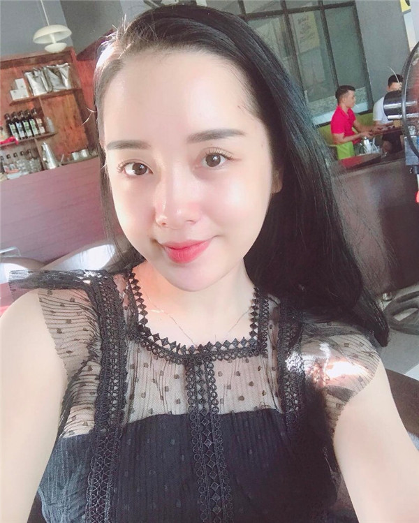 小姐姐们，进来看看我的神奇变美经历！自体脂肪丰太阳穴后脸部轮廓美的不行~~~~嗨嗨嗨拍照再也不用各种找角度了嘻嘻~~