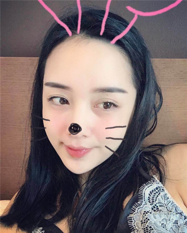 小姐姐们，进来看看我的神奇变美经历！自体脂肪丰太阳穴后脸部轮廓美的不行~~~~嗨嗨嗨拍照再也不用各种找角度了嘻嘻~~