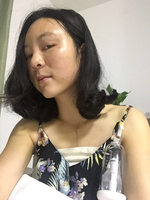 大家新年好呀!2018年我来给你们分享我的自体脂肪填充脸部案例啦~~素颜照、美照都有哦,嘻嘻(#^.^#)