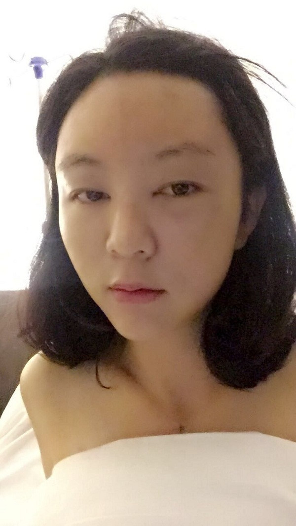 大家新年好呀!2018年我来给你们分享我的自体脂肪填充脸部案例啦~~素颜照、美照都有哦,嘻嘻(#^.^#)