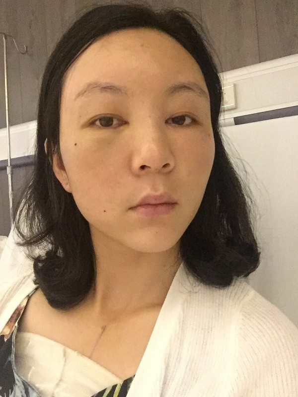 大家新年好呀!2018年我来给你们分享我的自体脂肪填充脸部案例啦~~素颜照、美照都有哦,嘻嘻(#^.^#)