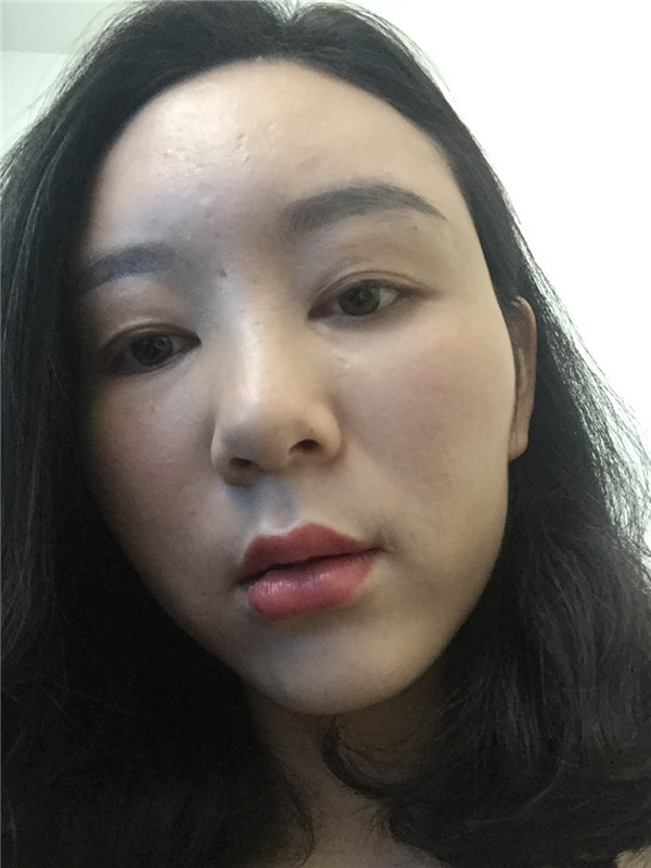 大家新年好呀!2018年我来给你们分享我的自体脂肪填充脸部案例啦~~素颜照、美照都有哦,嘻嘻(#^.^#)