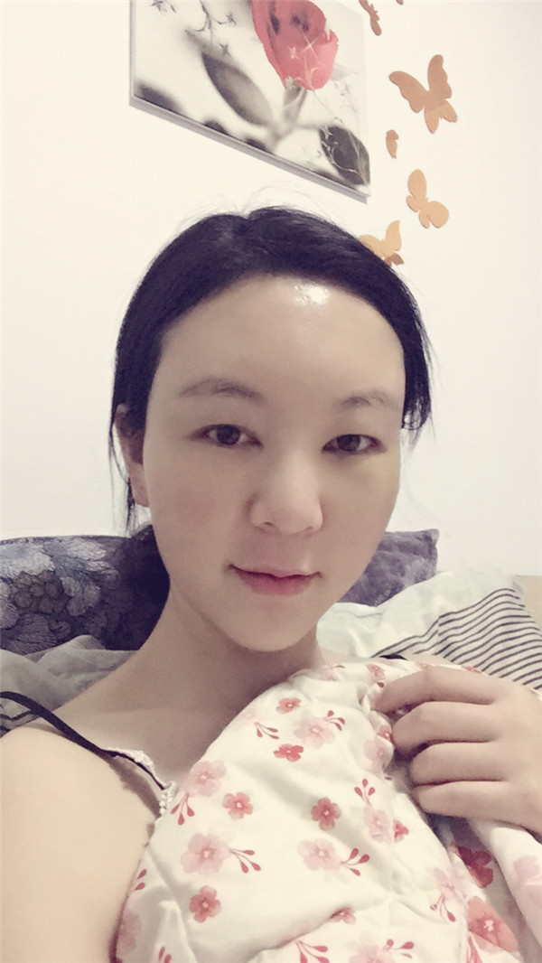 大家新年好呀!2018年我来给你们分享我的自体脂肪填充脸部案例啦~~素颜照、美照都有哦,嘻嘻(#^.^#)